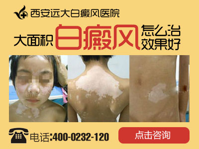大面积白癜风怎么治效果好.jpg