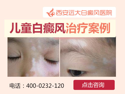 儿童白癜风治疗案例.jpg
