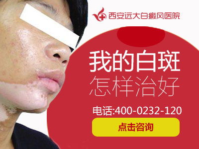 我的白斑怎样治好.jpg