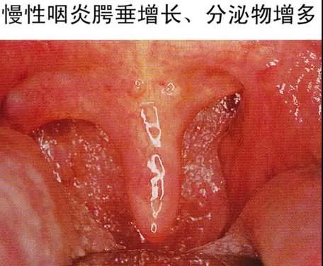 y慢性咽炎的危害.jpg