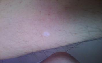 白殿疯病早期图片是什么样子的