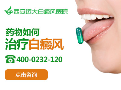 药物如何治疗白癜风.jpg