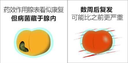 前列腺炎有哪些症状表现3.jpg