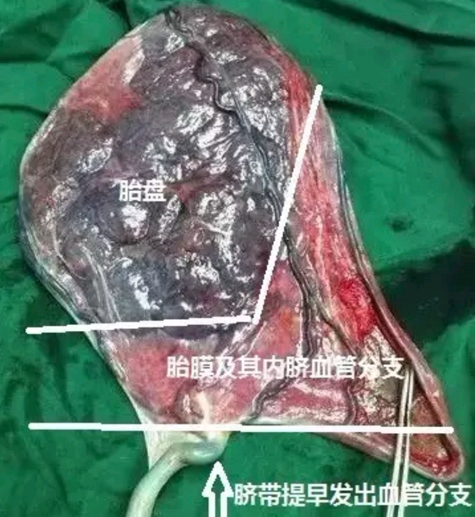 胎儿杀手之帆状胎盘——什么是帆状胎盘?