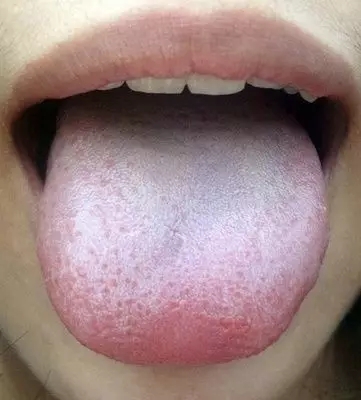 寒性体质是肿瘤的温床,提升人体阳气,助您远离"癌状态