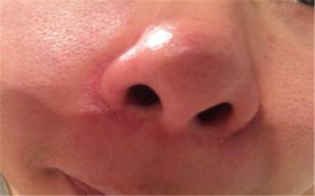 引起酒糟鼻的原因是什么?_李建红