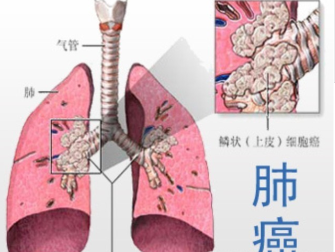 肺癌晚期症状有哪些