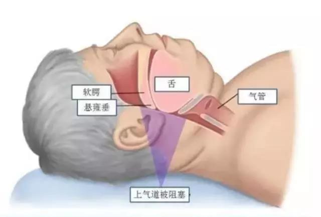 h鼾症图-贵州省第二人民医院耳鼻喉科.png