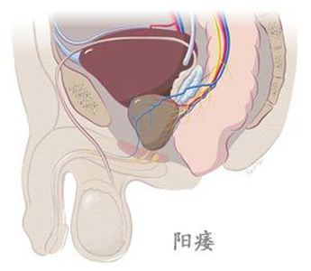 阳痿.jpg