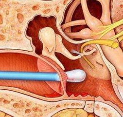 掏耳朵竟然会引起外耳道炎-贵州省第二人民医院耳鼻喉科解析