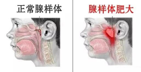 y贵州省二医耳鼻喉科腺样体对比图.png