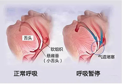 h小儿鼾症示意图.png