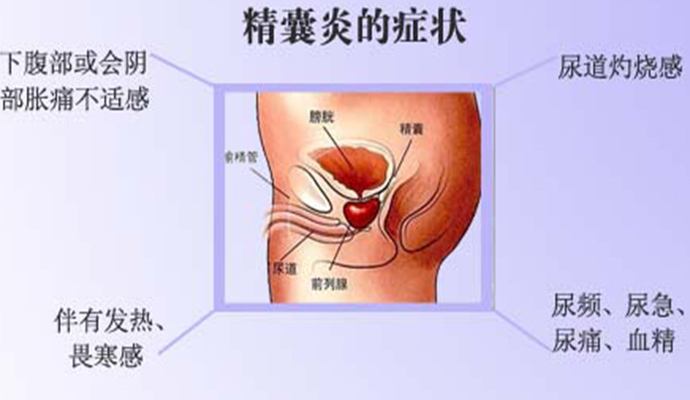 男性精囊炎出现的前兆主要有哪些?