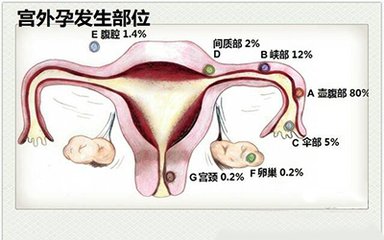 宫外孕.jpg