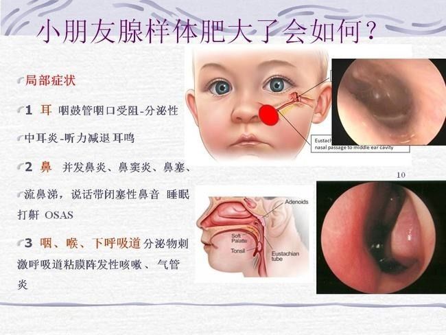 y腺样体肥大有哪些症状2.jpg