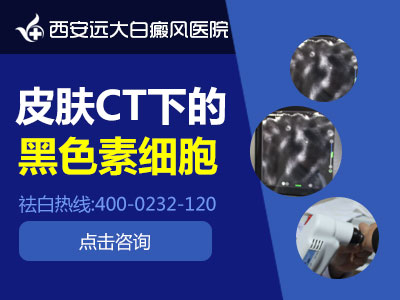 皮肤CT下的黑色素细胞.jpg