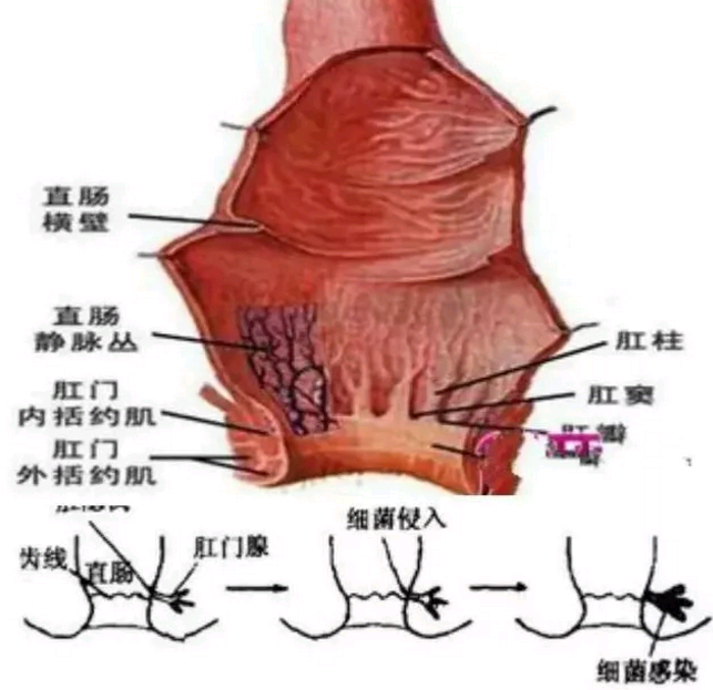 3, 肛门周围的刺激和损伤.