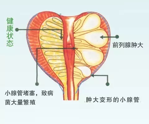 急性前列腺2.webp.jpg