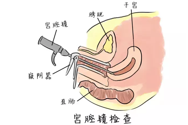 而宫腔内的疾病具有一定的隐匿性,需要通过宫腔镜检查的方式才能确