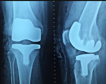 膝关节置换术适应症