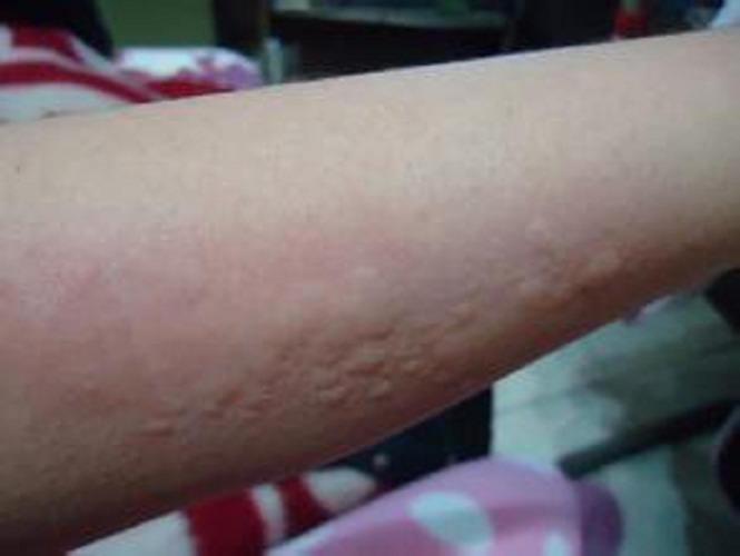 红肿的丘疹性荨麻疹症状图片