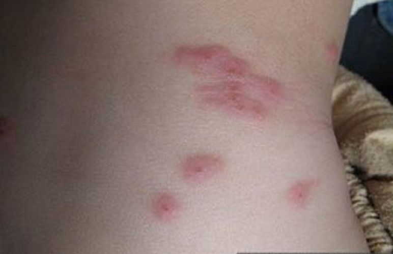 丘疹性荨麻疹真实照片图片