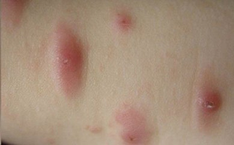 大人丘疹性荨麻疹图片图片