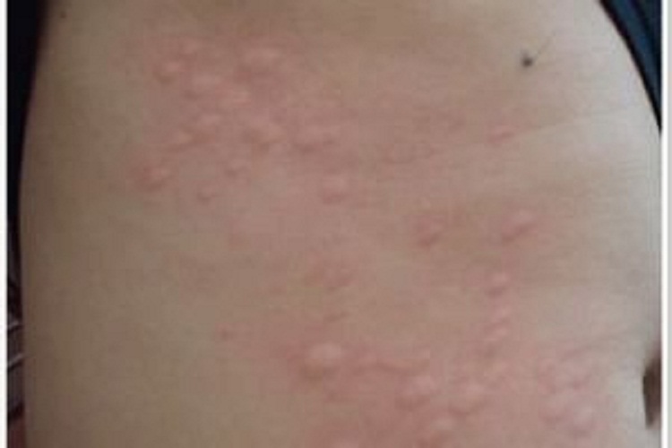 皮肤上丘疹性荨麻疹症状初期