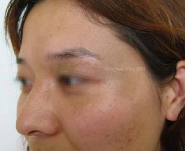 轻微太田痣图片