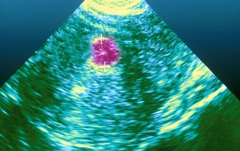 子宫肌瘤的诊断：检查和图像