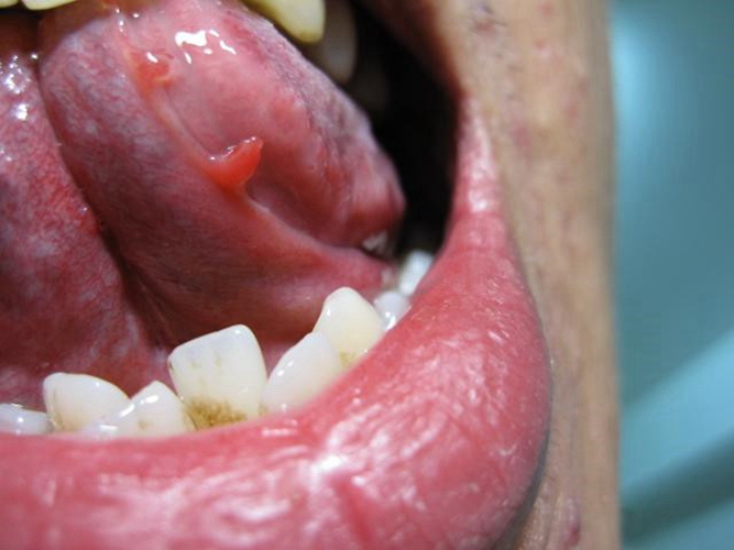 口腔疣初期图片图片