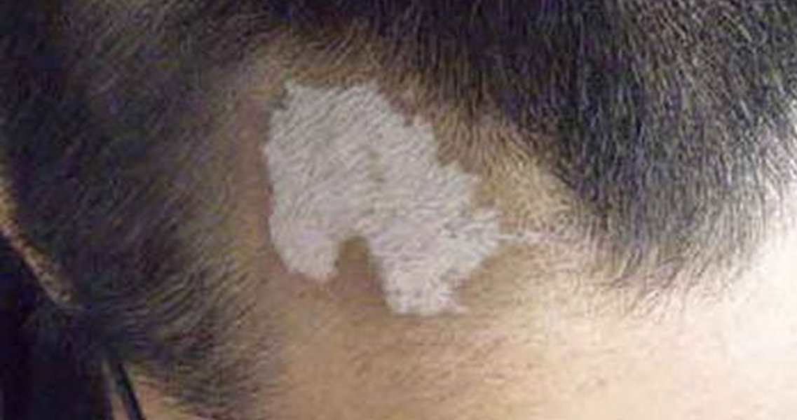 刚开始长白癜风的图片