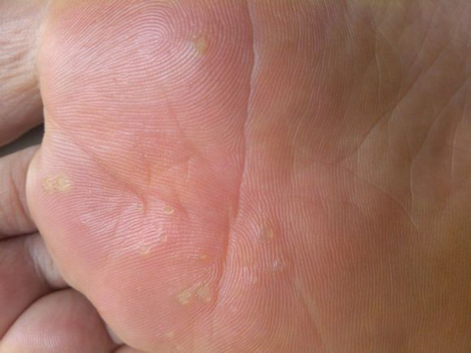 跖疣治好的图片