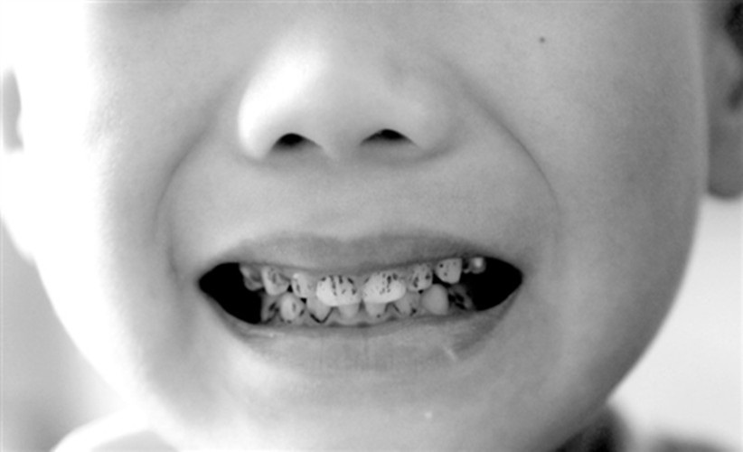 4岁儿童牙齿发黑龋齿图片