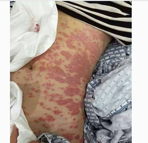 红斑狼疮晚期图