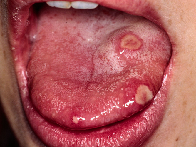 艾滋病初期舌头症状图片