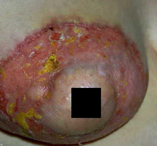 乳腺癌皮肤 早期症状图片