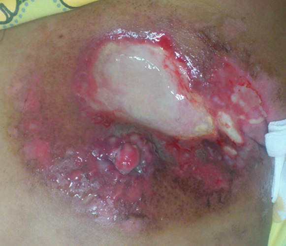 乳腺癌红肿溃烂的图片图片