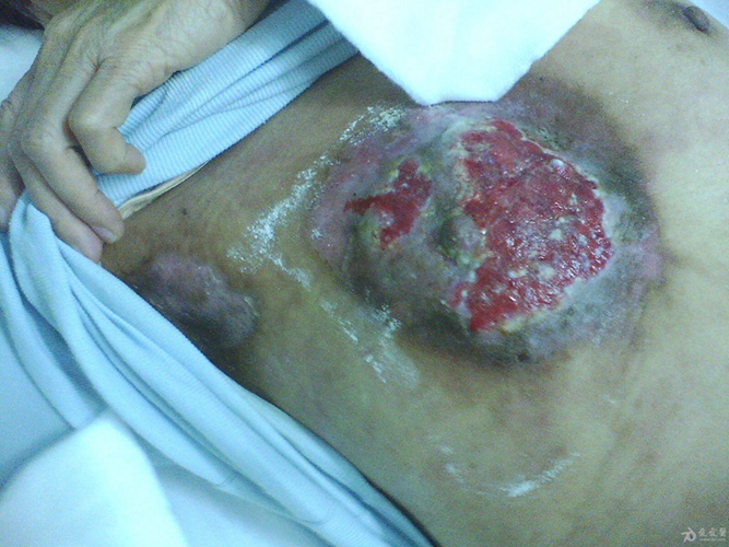 乳腺癌 乳房红斑 图片图片
