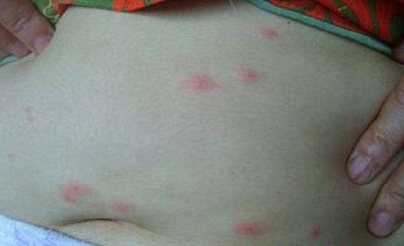 丘疹性荨麻疹传染吗图片