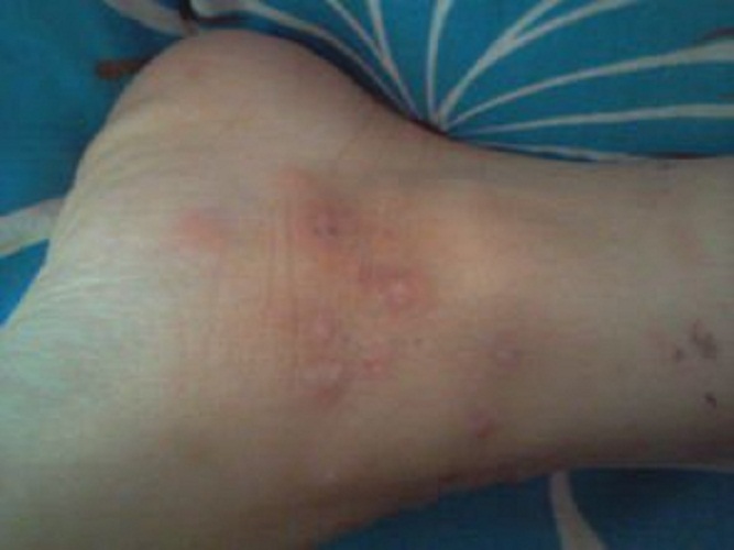 脚上丘疹性荨麻疹症状图片
