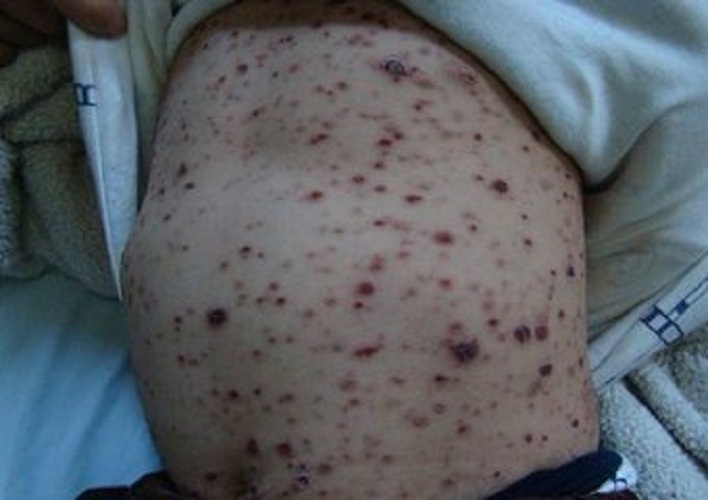 严重丘疹性荨麻疹图片