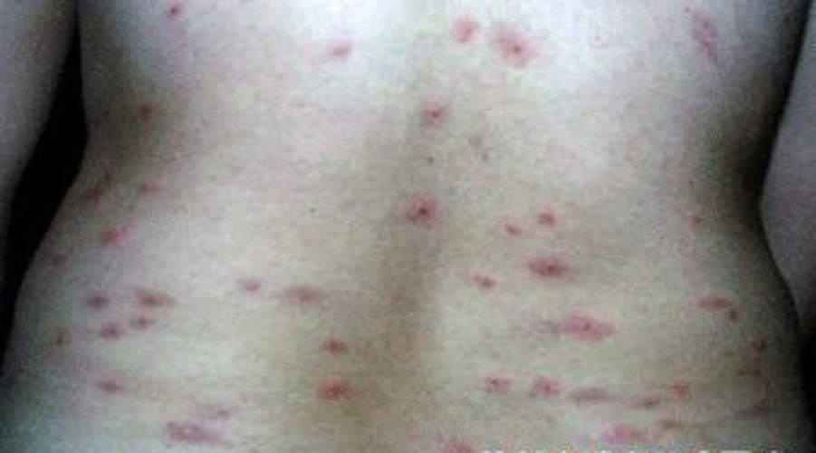 人工性荨麻疹症状图片