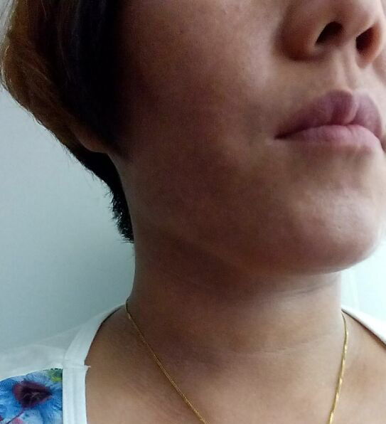 皮肤黑变病早期症状图片