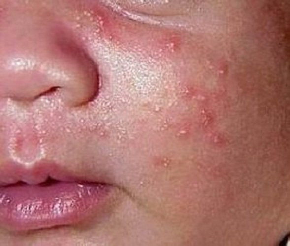 脸上水痘状丘疹性荨麻疹症状图片