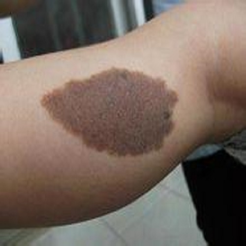 咖啡色太田痣图片