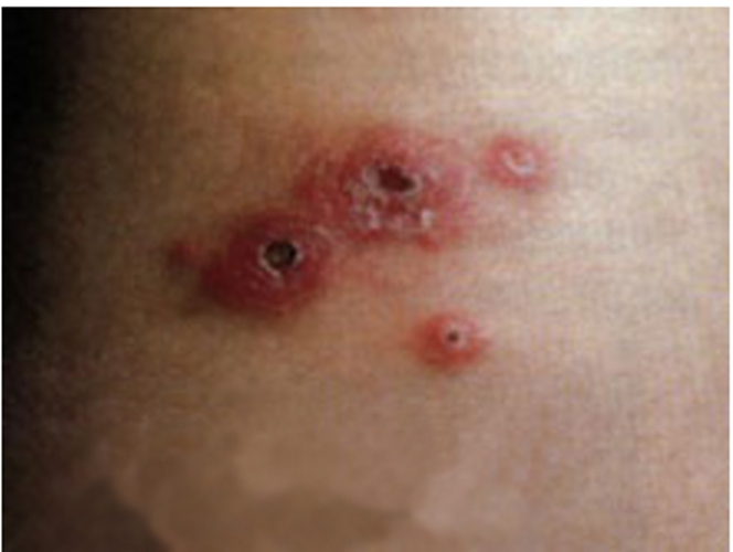女性疱疹早期图片图片