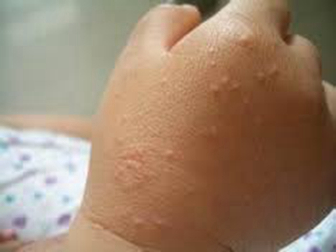 儿童皮炎早期症状图片图片