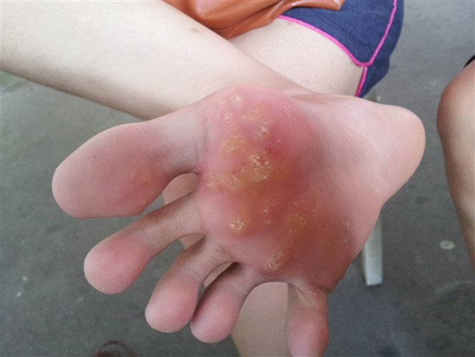 跖疣图片后期图片