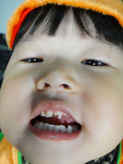 儿童早期虫吃牙图片图片
